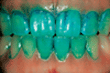Farbtabletten zur Erkennung von Zahnbelag