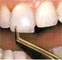 Veneers